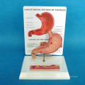 Menschlicher Magen Anatomisches Magengeschwür Medizinisches Demonstrationsmodell (R100208)